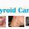 Papillary Thyroid Cancer Symptoms