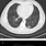 Pulmonary Nodule CT