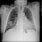 Pulmonary Nodule CXR