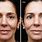 Radio Frequency Skin Tightening Before and After