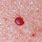 Red Blood Moles On Skin