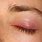 Red Swollen Upper Eyelid