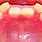 Retroclined Incisors