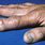 Rheumatoid Nodules On Fingers