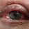 Severe Eye Allergies
