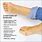 Signs of Bunions