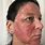 Skin Cancer Cream for Face