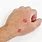 Skin Lesions On Hands