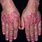 Skin Rash Lupus Erythematosus