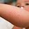 Skin Rashes On Children