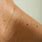 Skin Tags Under Arms