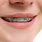 Small Teeth with Braces