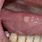 Sores On Tongue Causes