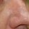 Squamous Cell Cancer Nose