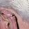 Squamous Cell Cancer On Ear