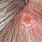 Squamous Cell Carcinoma On Scalp