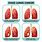 Stage 4 Small Cell Lung Cancer