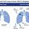 Staging of Small Cell Lung Cancer