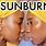 SunBurn On Dark Skin
