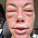 Swollen Face Allergic Reaction