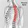 Thoracic Spine Radiculopathy