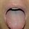 Tongue Warts