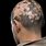 Toxic Alopecia