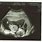Twin Ultrasound at 15 Weeks