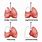 Types of Lung Surgery