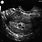 Ultrasound at 3 Weeks Pregnant