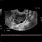 Ultrasound of Ovarian Cyst
