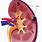 Upper Pole Kidney Cyst