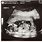 Week 16 Pregnancy Ultrasound