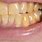 Yellow Stains On Teeth