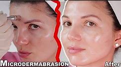 MICRODERMABRASION at home (2021)- skin expert FULL procedure and before and after results