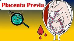 Placenta Previa - Causes, Risk Factors, Signs & Symptoms, Diagnosis, And Treatment