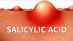 Here's WHY Salicylic Acid is Best For ACNE