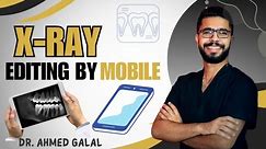 X- ray editing and quality enhancement by mobile || Dr. Ahmed Galal