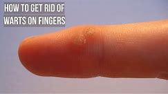 How to Get Rid of Warts on Fingers