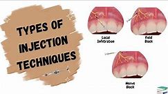 Types of Injections used in Dentistry | Local Anesthesia