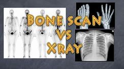 How are bone scans related to x-rays