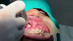 Surgical removal of Labially Impacted Maxillary Canine