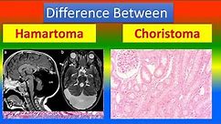 Difference between Hamartoma and choristoma
