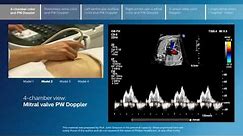 Advanced screening views of the fetal heart - Part 1 - 4-chamber color and PW Doppler