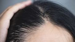 What you should know about PRP treatments for hair loss
