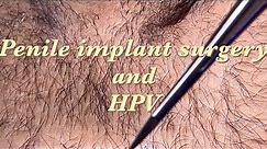 #2 Case of Penile Enhancement Implant Surgery Triggered Hidden HPV warts Growth