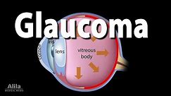 Development of Glaucoma Animation, Open Angle vs Angle Closure Glaucoma.
