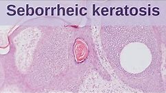 Seborrheic Keratosis - Pathology mini tutorial