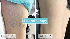 Sclerotherapy Leg Vein Treatment | The Laser and Skin Clinic