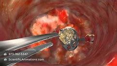 Medical Animation of CO2 Laser Surgery
